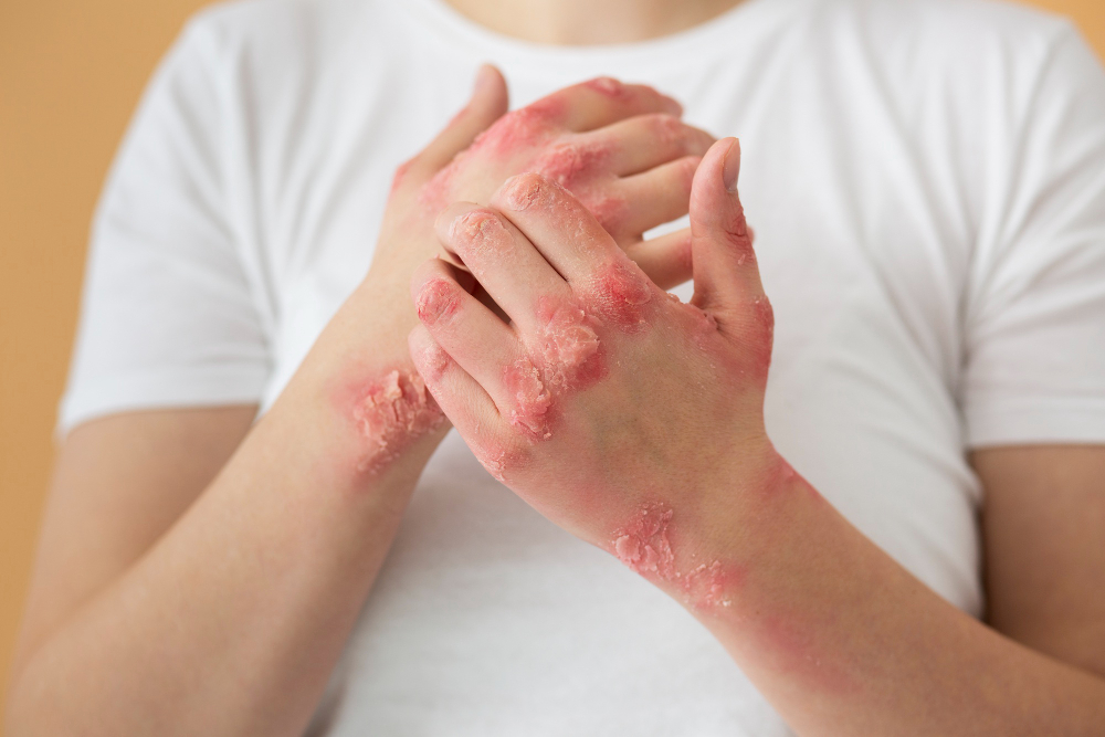 Monsoon Fungal Infections: Symptoms, Causes, Treatment & Prevention Guide